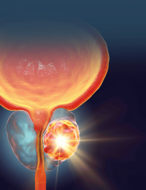 Cirugia Cancer de Prostata Prostaclinic Leon Guanajuato