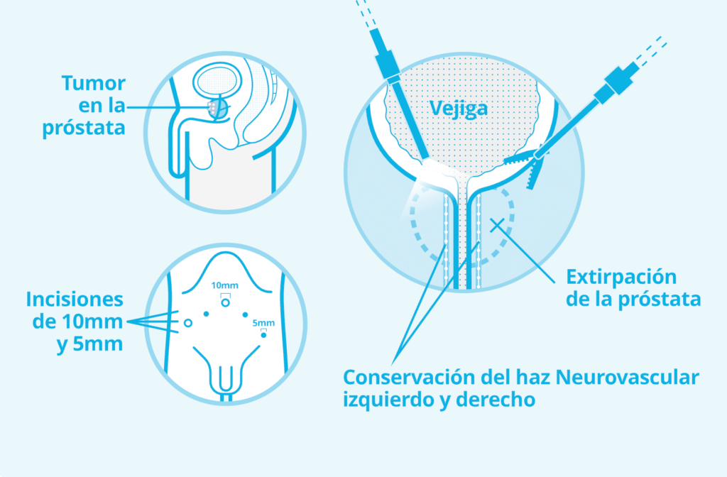Prostatectomia Radical Laparoscopica en ProstaClinic
